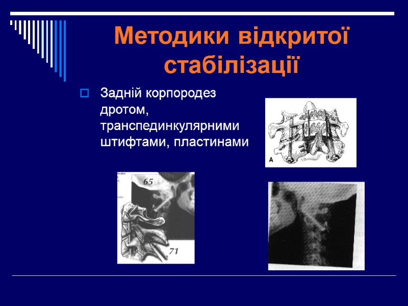 Методики відкритої стабілізації Задній корпородез дротом, транспединкулярними штифтами, пластинами